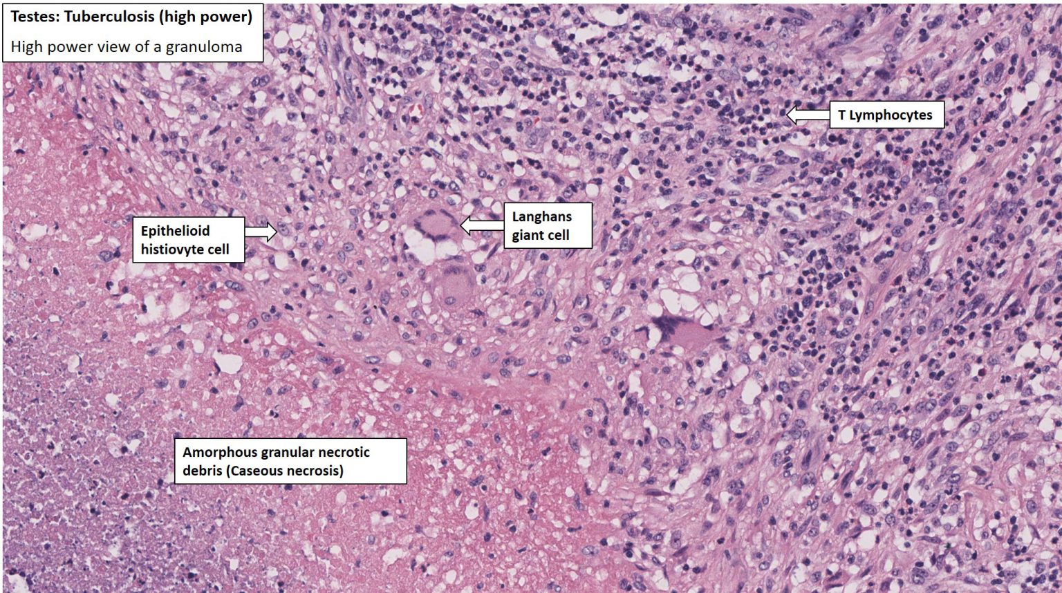 Testis – Tuberculous Epididymitis – NUS Pathweb :: NUS Pathweb