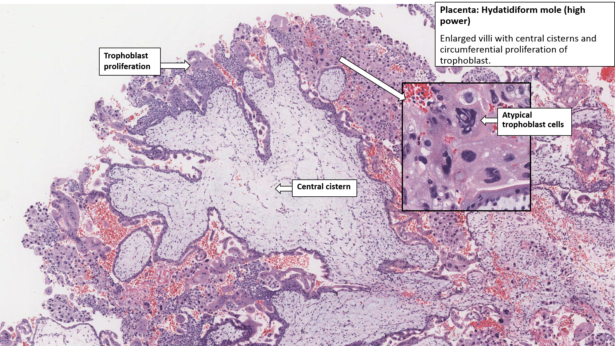 Uterus and Placenta – Hydatidiform Mole – NUS Pathweb :: NUS Pathweb