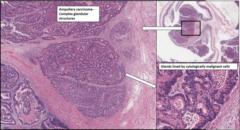 Duodenum And Pancreas – Ampullary Carcinoma – NUS Pathweb :: NUS Pathweb