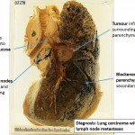Lung-ca-annotated-26p4y73-150x150