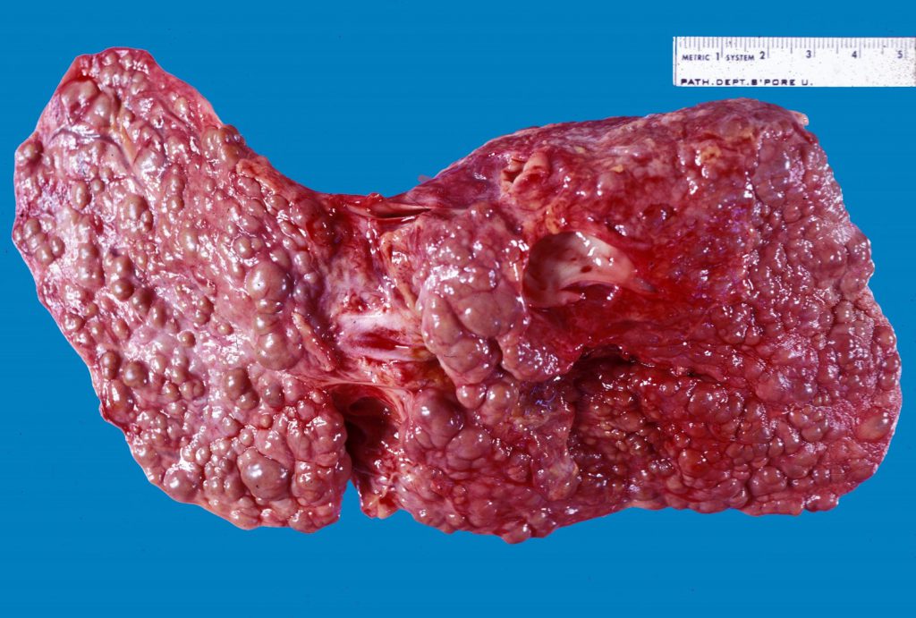 Liver-Cirrhosis-12clmp2