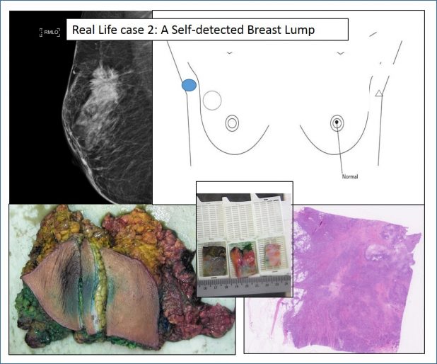 breast real life case