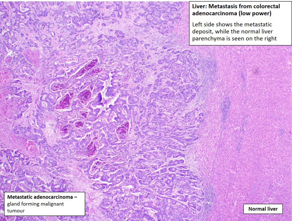 Liver – Metastatic Carcinoma – NUS Pathweb :: NUS Pathweb