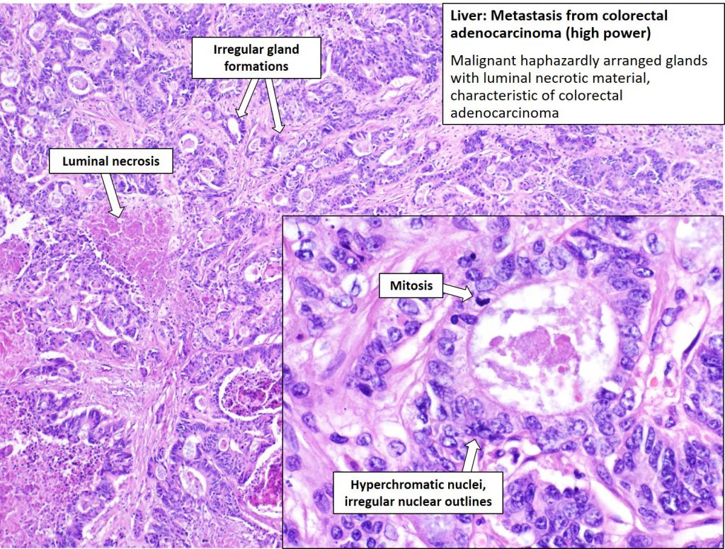 Liver – Metastatic Carcinoma – Nus Pathweb :: Nus Pathweb