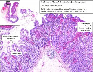 Intestine – Meckel's Diverticulum – NUS Pathweb :: NUS Pathweb