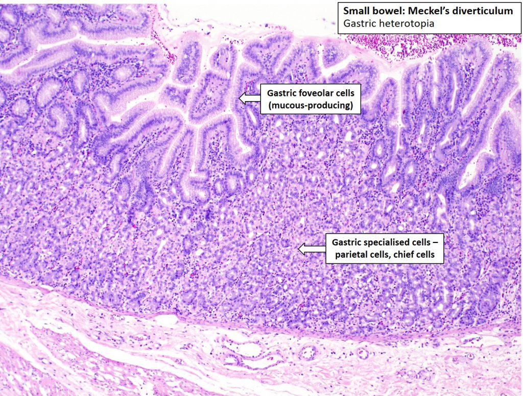 Intestine – Meckel's Diverticulum – NUS Pathweb :: NUS Pathweb