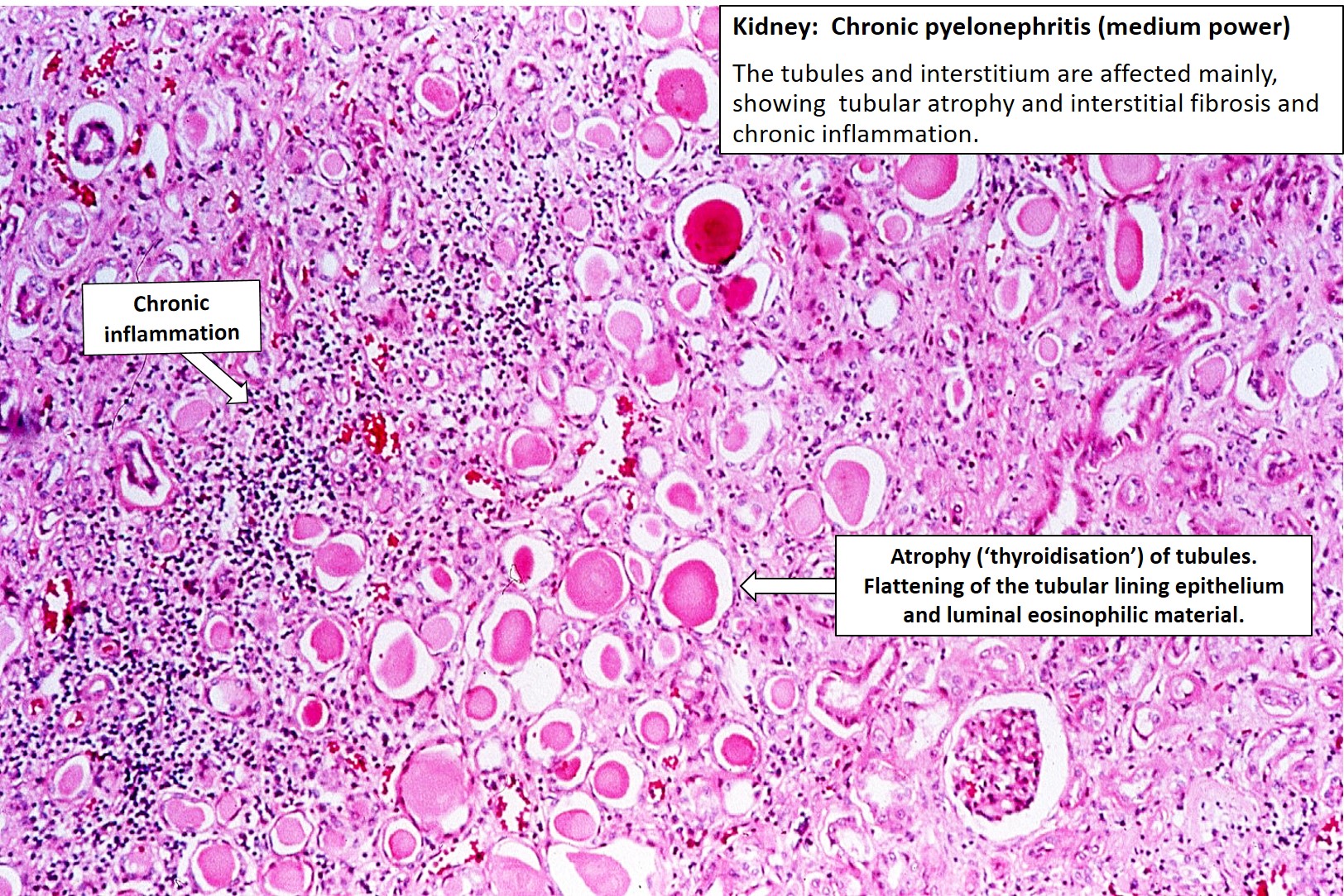 chronic pyelonephritis histology