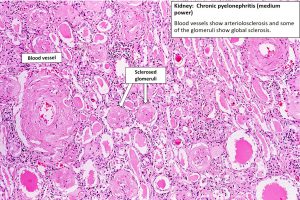 Kidney – Chronic Pyelonephritis – NUS Pathweb :: NUS Pathweb