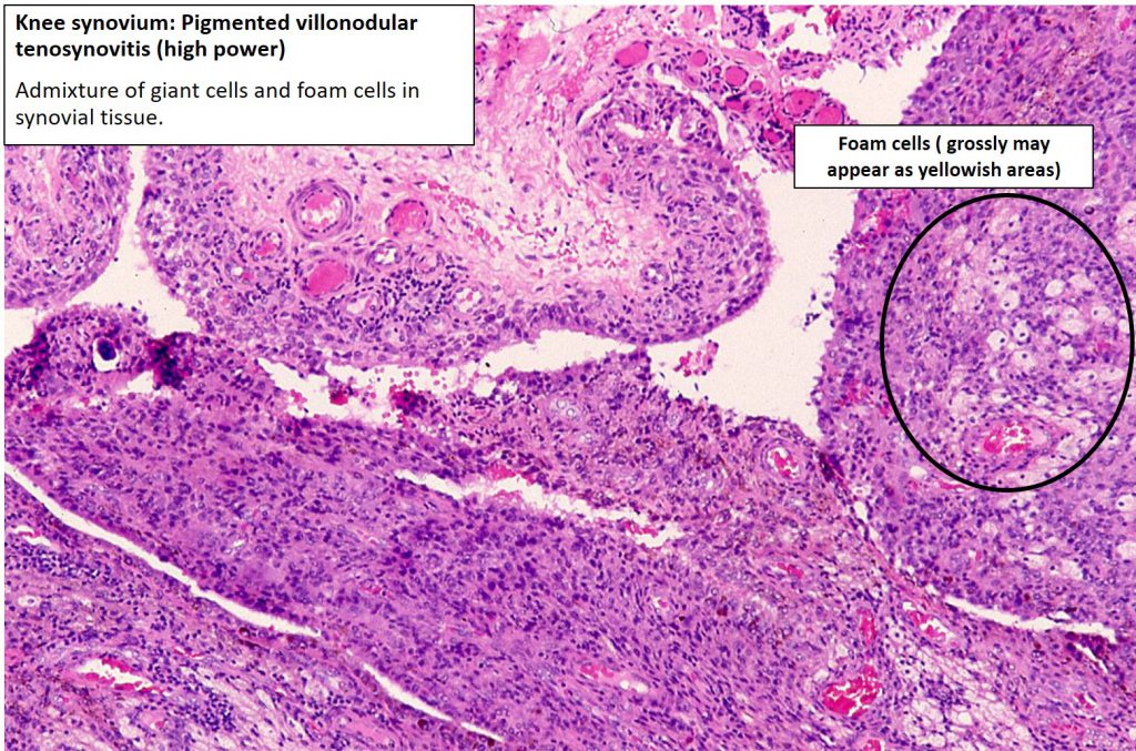 Knee – Villonodular synovitis (knee)/Tenosynovial giant cell tumour ...