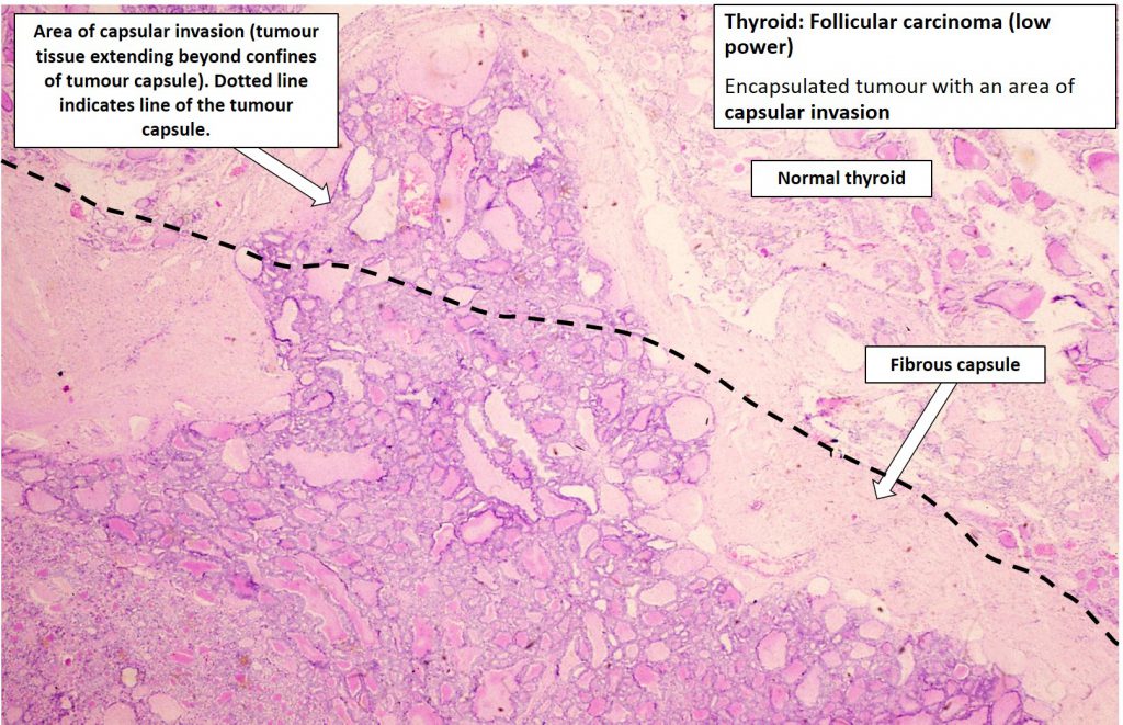 Thyroid – Follicular Carcinoma – NUS Pathweb :: NUS Pathweb