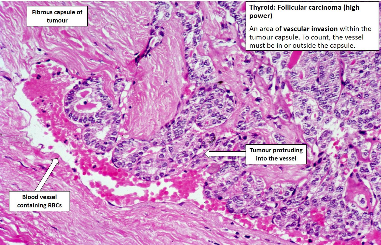 Thyroid – Follicular Carcinoma – Nus Pathweb Nus Pathweb