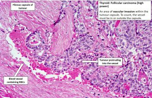 Thyroid – Follicular Carcinoma – NUS Pathweb :: NUS Pathweb