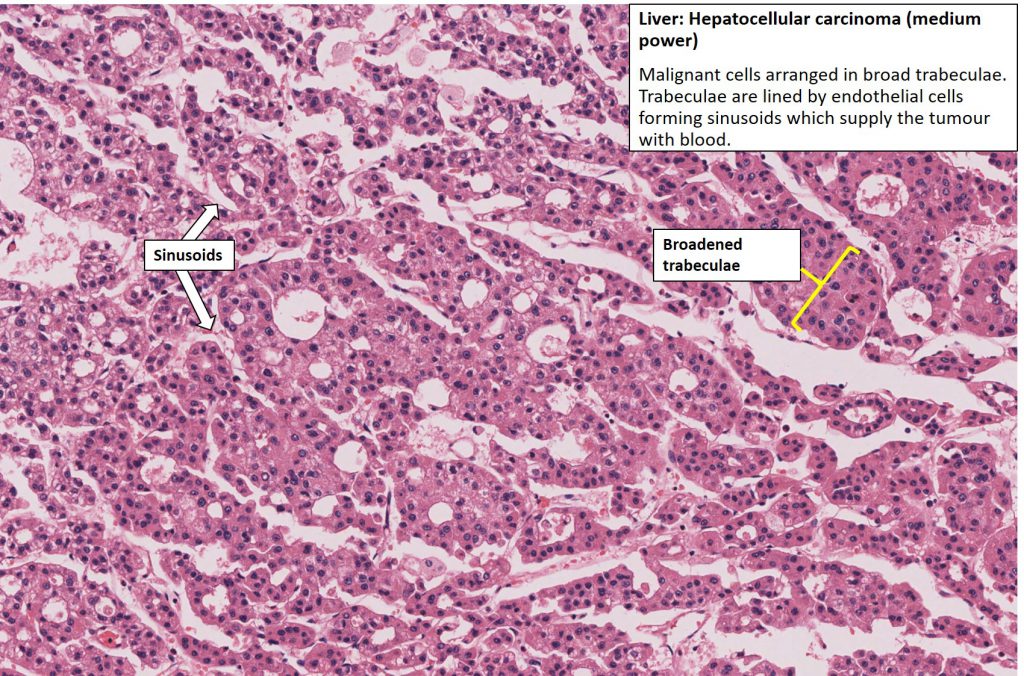 Liver Cirrhosis With Hepatocellular Carcinoma Nus Pathweb Nus Pathweb