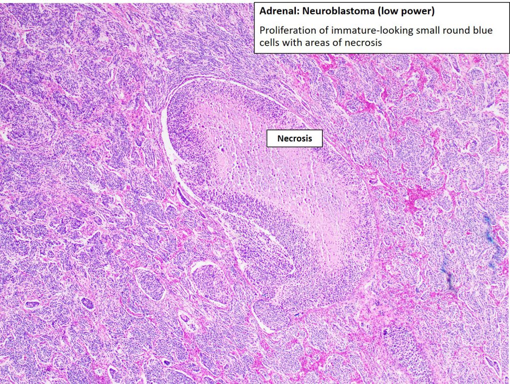 Adrenal – Neuroblastoma – NUS Pathweb :: NUS Pathweb