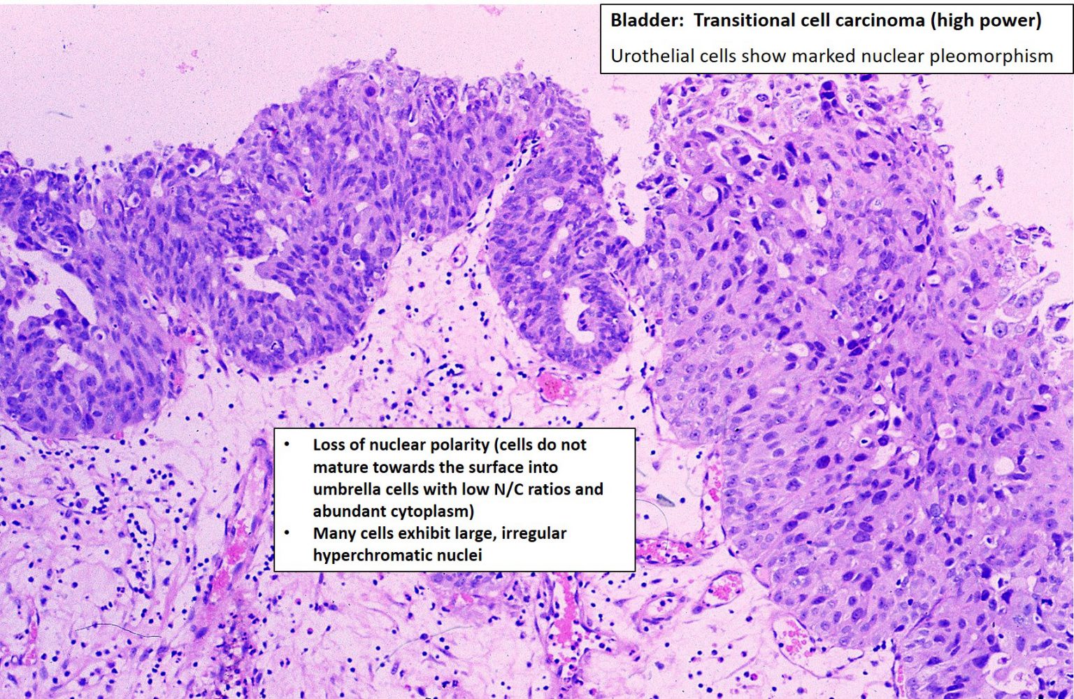 Bladder – Urothelial carcinoma – NUS Pathweb :: NUS Pathweb