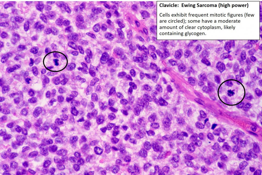 Clavicle Ewings Sarcoma Nus Pathweb Nus Pathweb 8794