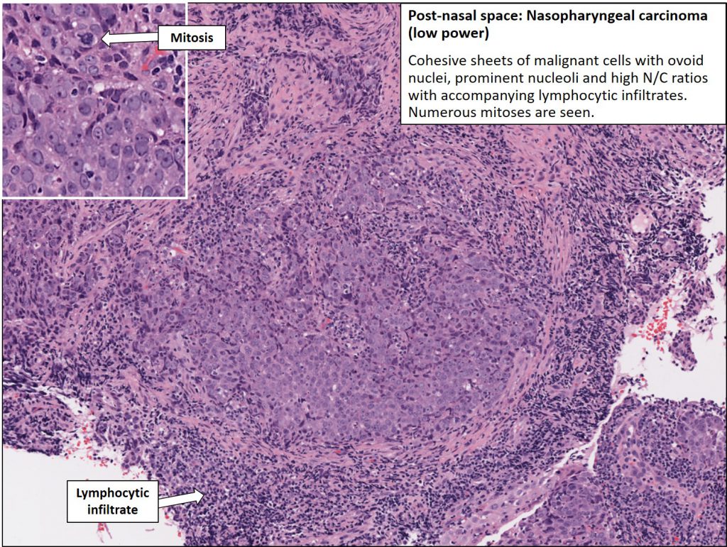 Head – Nasopharyngeal Carcinoma – NUS Pathweb :: NUS Pathweb