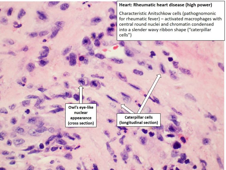 Heart Rheumatic Heart Disease Nus Pathweb 