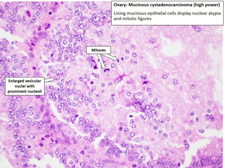 Ovary – Mucinous carcinoma (Mucinous cystadenocarcinoma) – NUS Pathweb ...