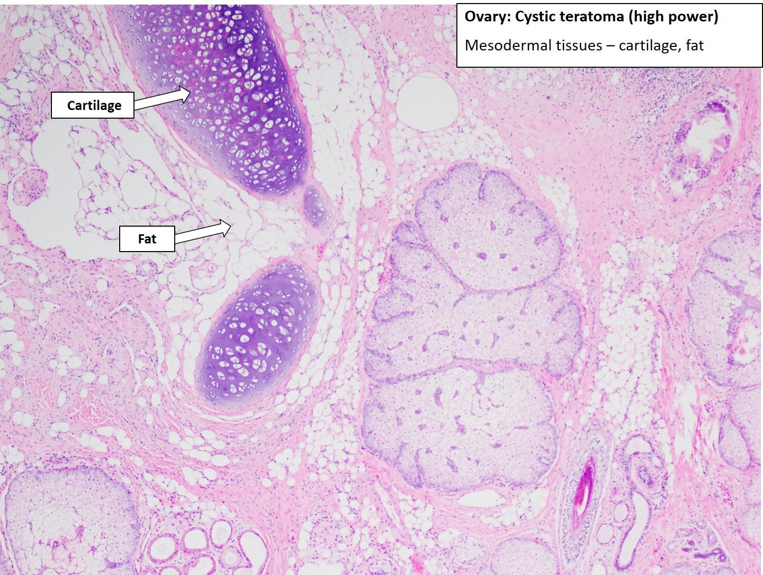 Ovary Cystic Teratoma NUS Pathweb NUS Pathweb Ovary Cystic Teratoma NUS Pathweb NUS Pathweb