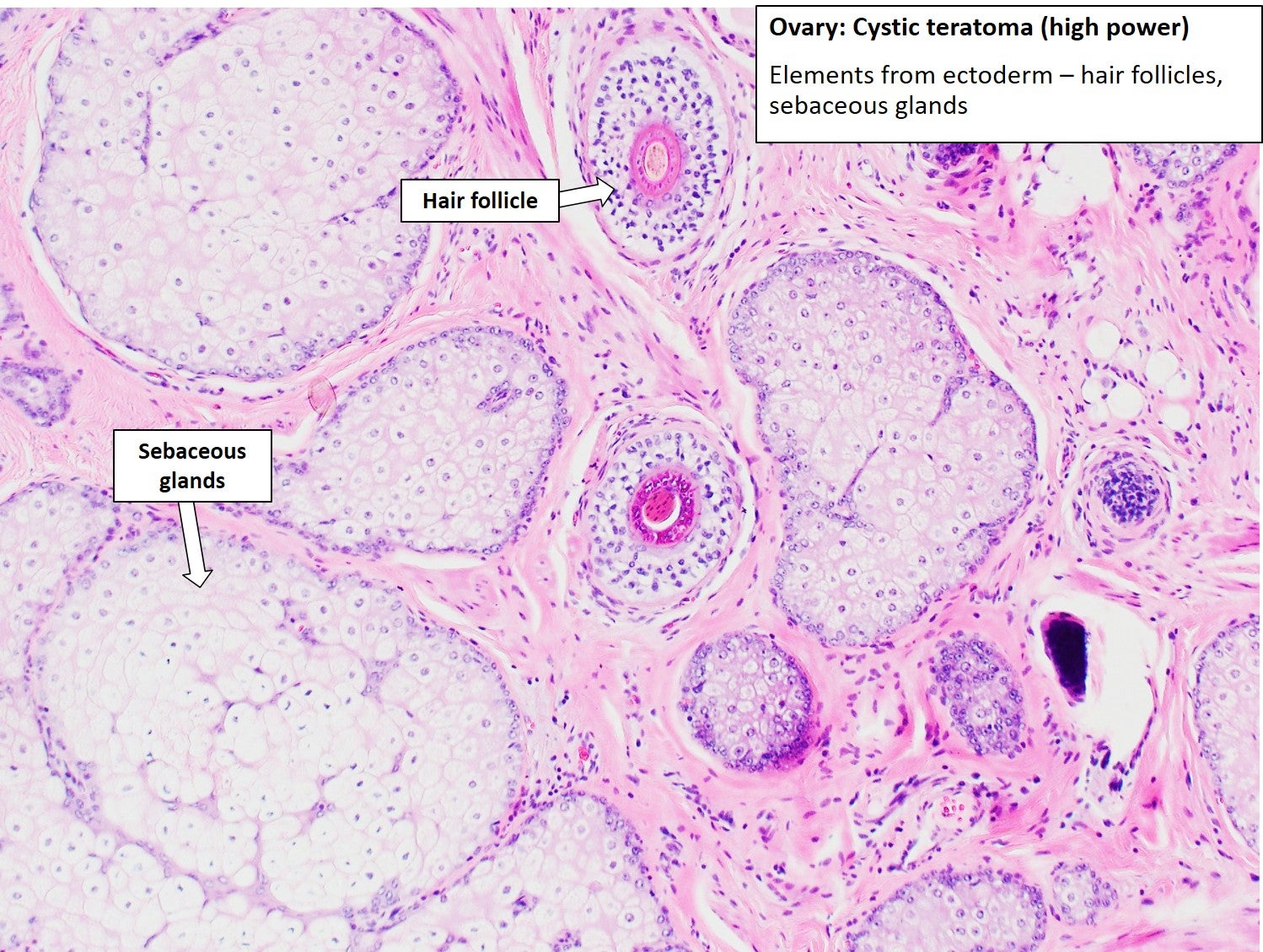 Teratoma Histology Teratoma Histology
