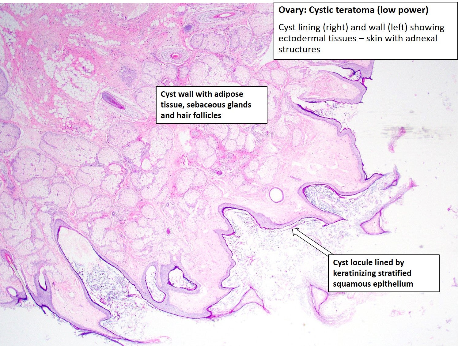 Ovary Cystic Teratoma NUS Pathweb NUS Pathweb Ovary Cystic Teratoma NUS Pathweb NUS Pathweb