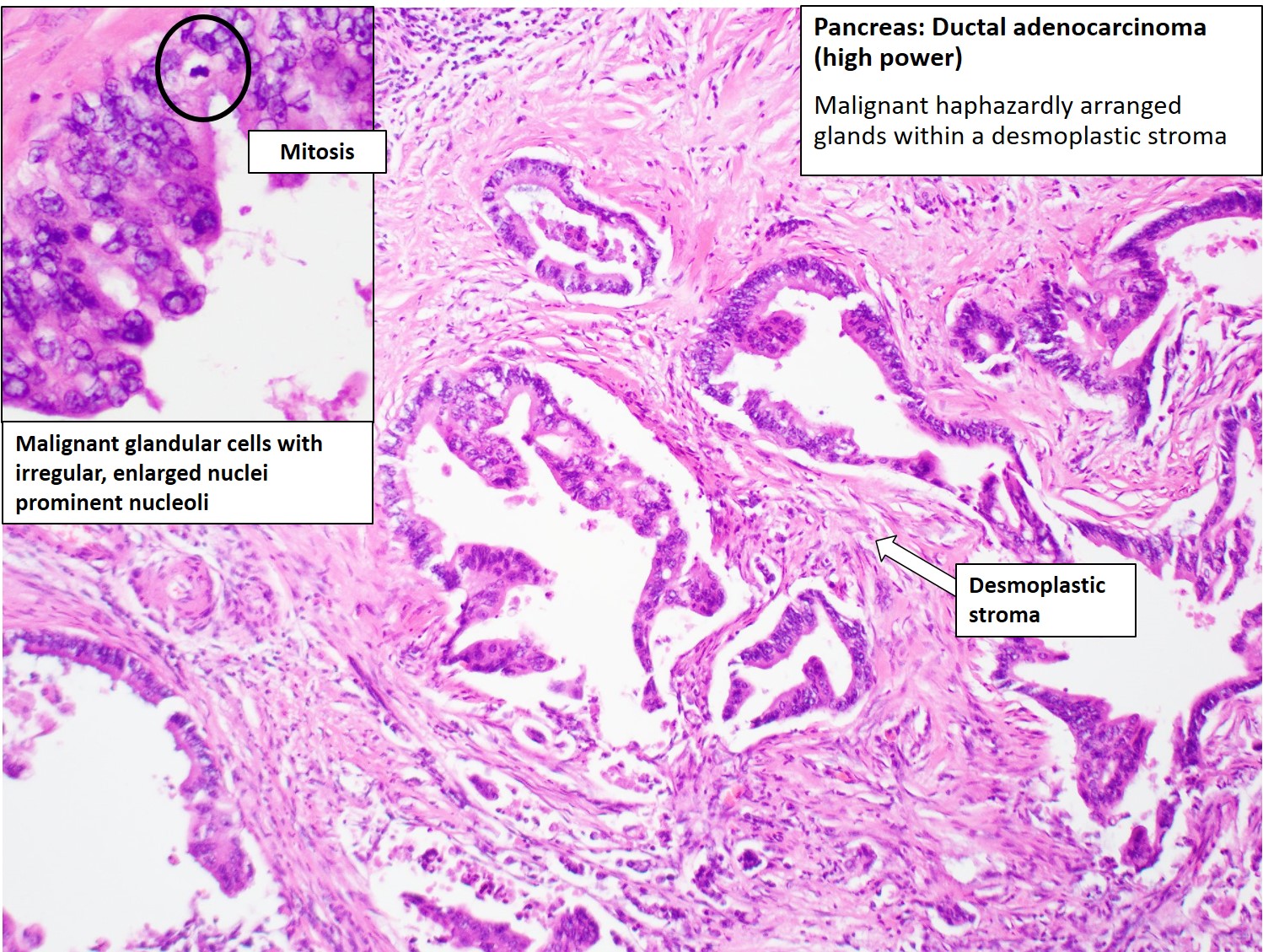 adenocarcinoma pancreas – adénocarcinome pancréatique métastatique ...