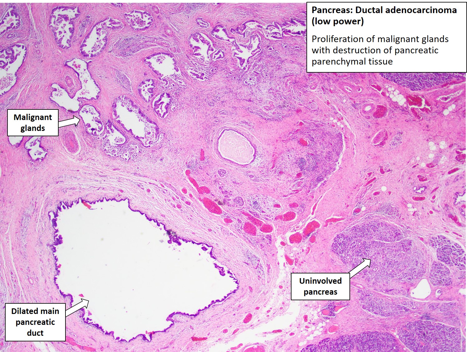 Histology Of Pancreatic Ductal Adenocarcinoma Created With | Sexiz Pix