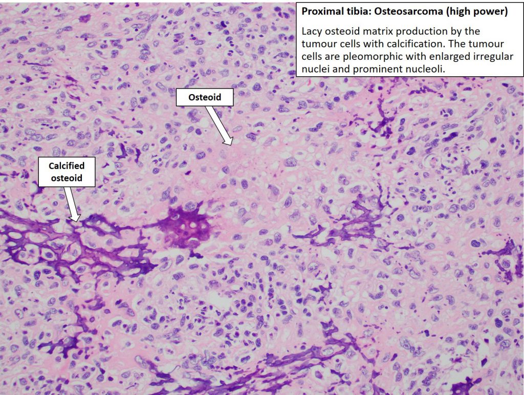 Knee – Osteosarcoma – NUS Pathweb :: NUS Pathweb