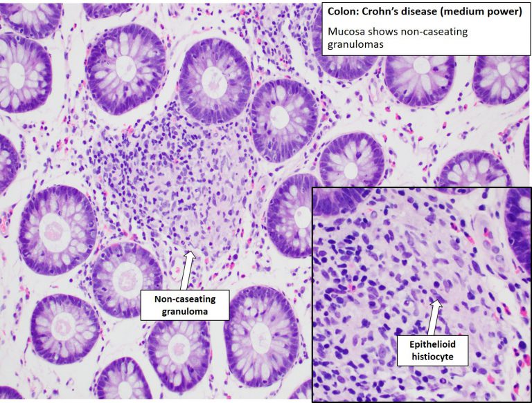 Colon Crohn's Disease NUS Pathweb NUS Pathweb