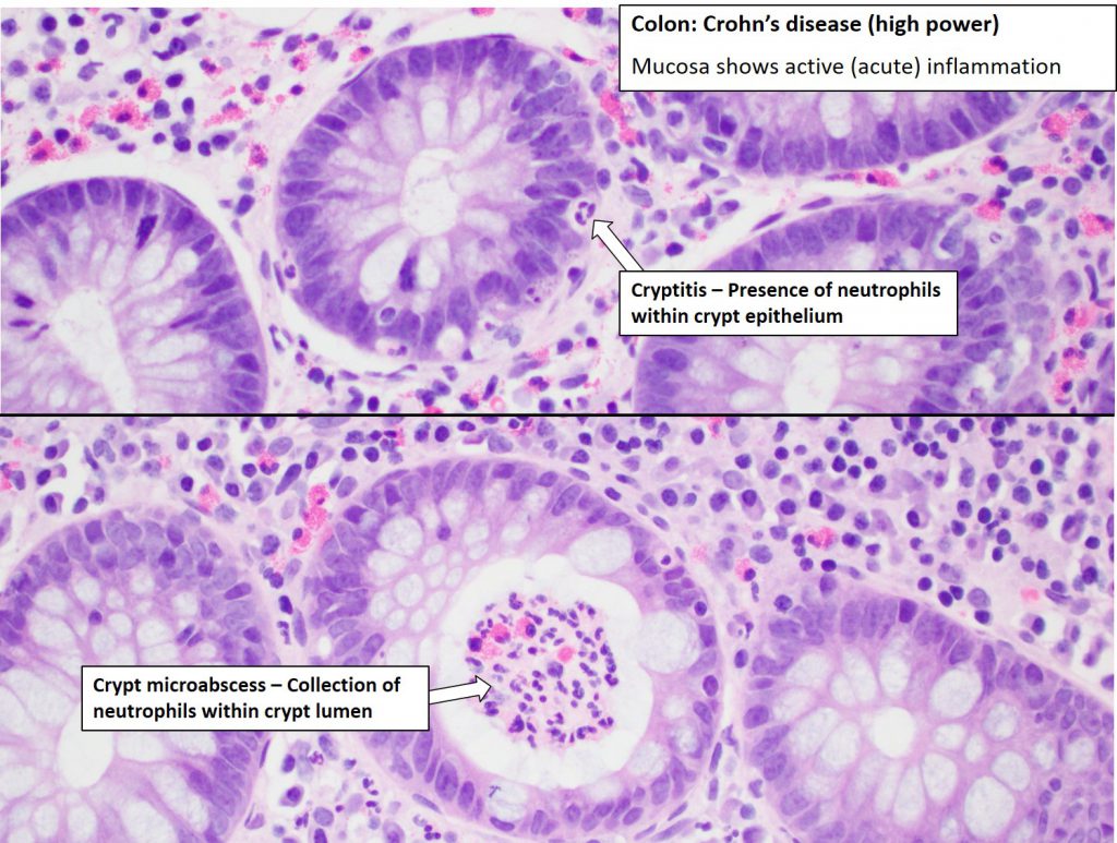 Colon Crohn S Disease Nus Pathweb Nus Pathweb