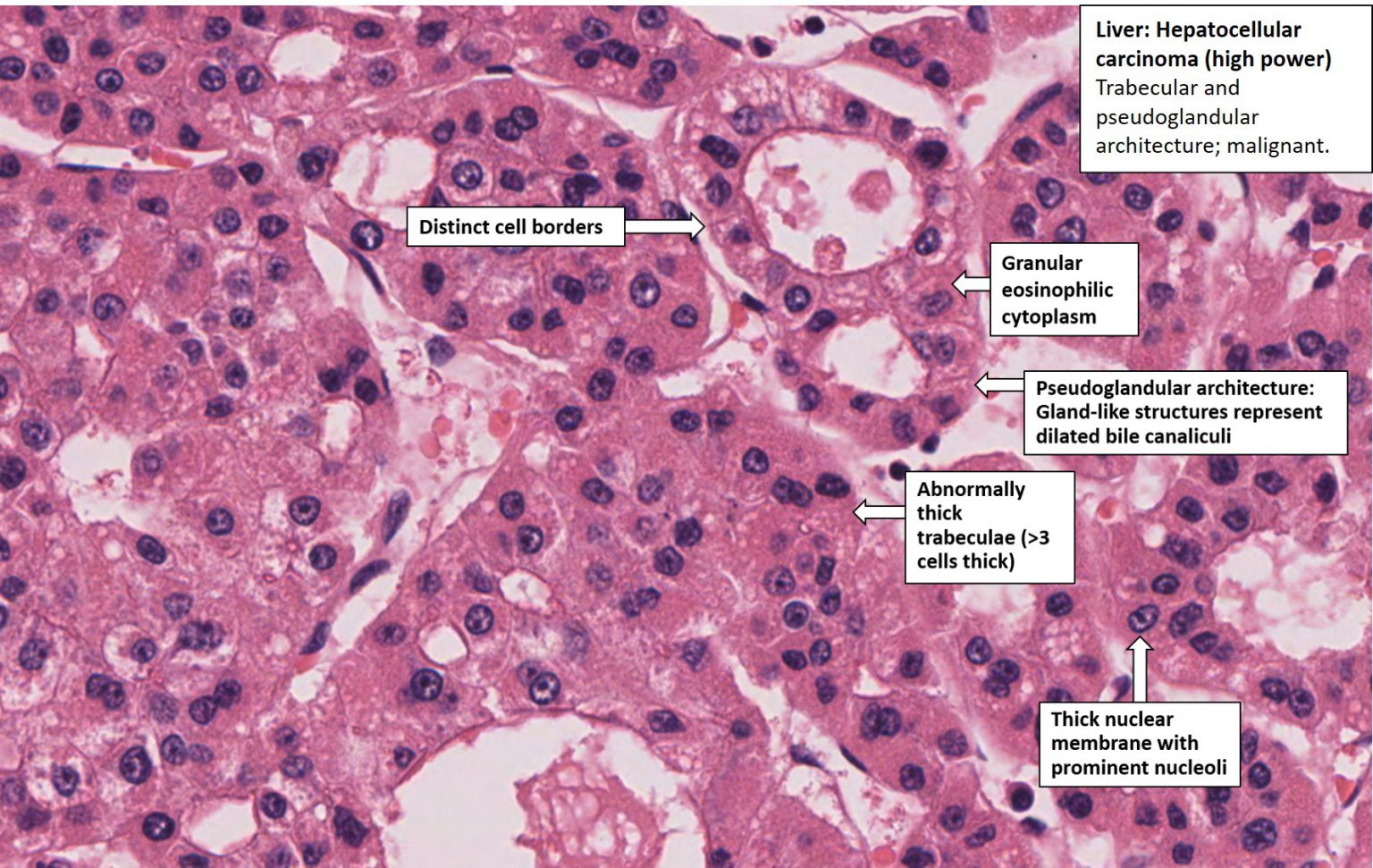 Liver – Hepatocellular Carcinoma – NUS Pathweb :: NUS Pathweb