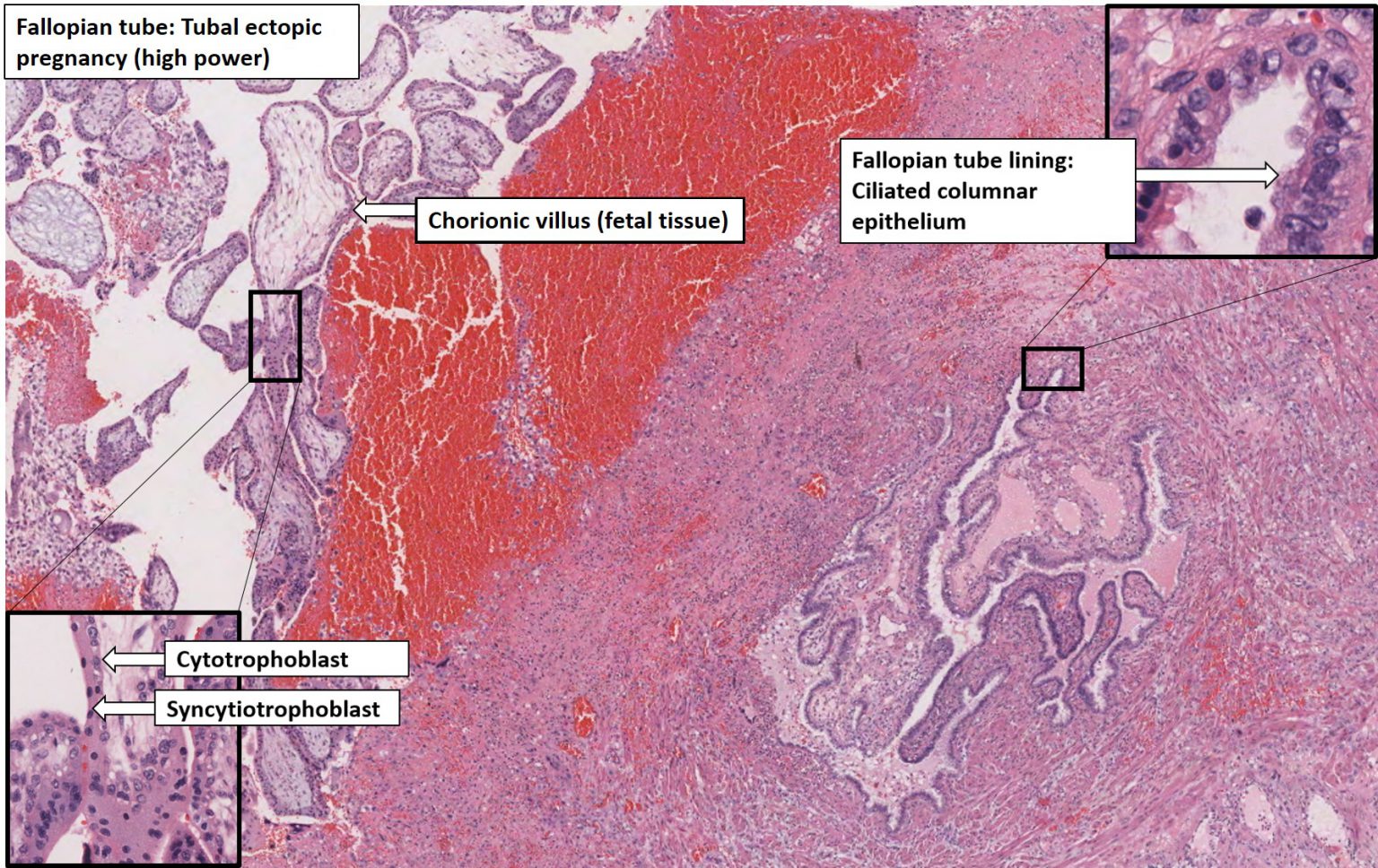 Fallopian Tube – Tubal Ectopic Pregnancy – NUS Pathweb :: NUS Pathweb