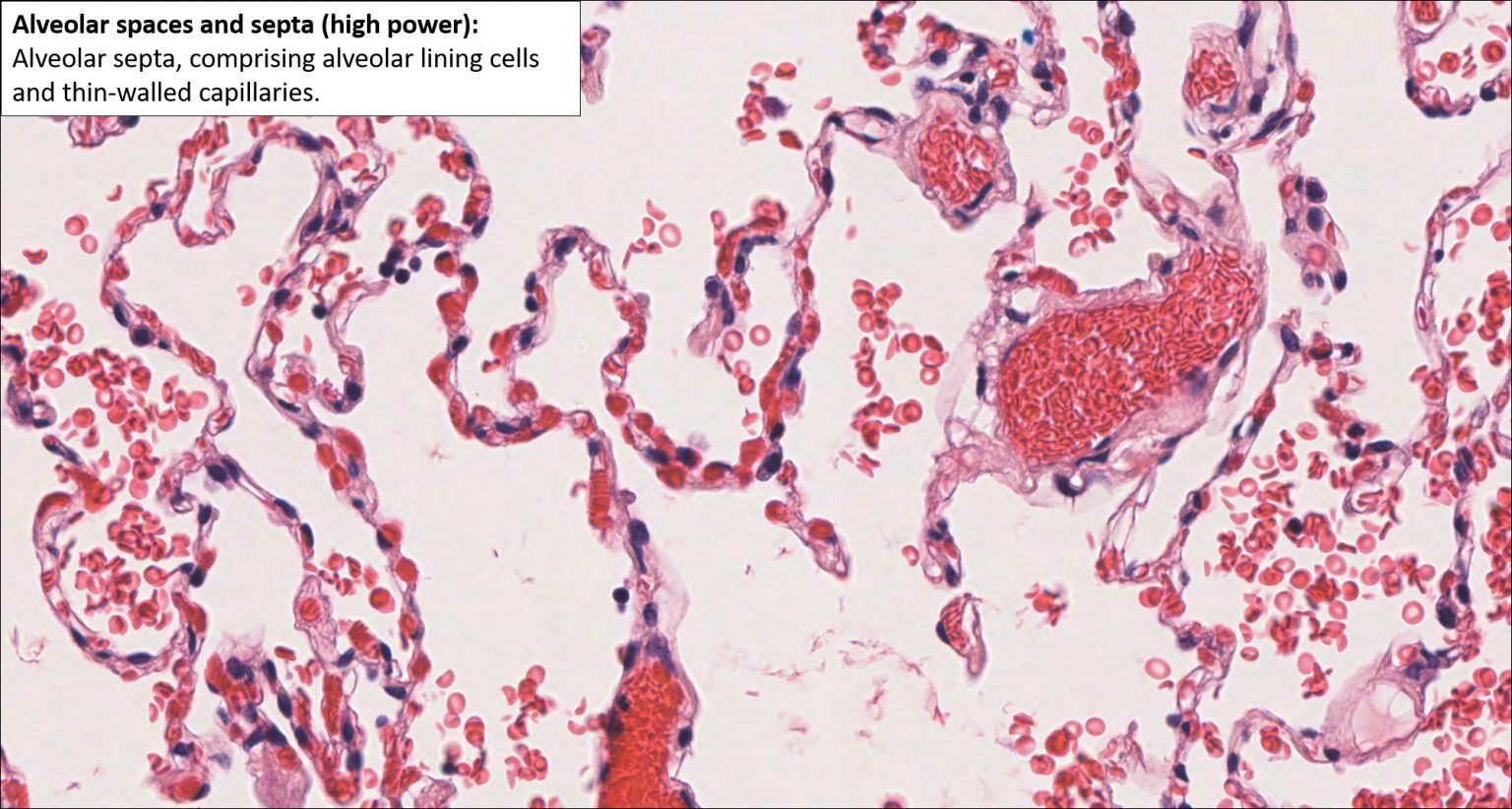 Lung Normal Histology Nus Pathweb Nus Pathweb