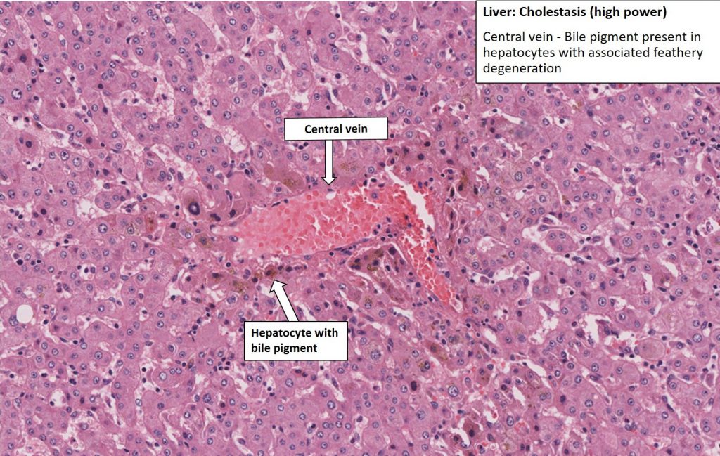 Liver – Choledocholithiasis – NUS Pathweb :: NUS Pathweb