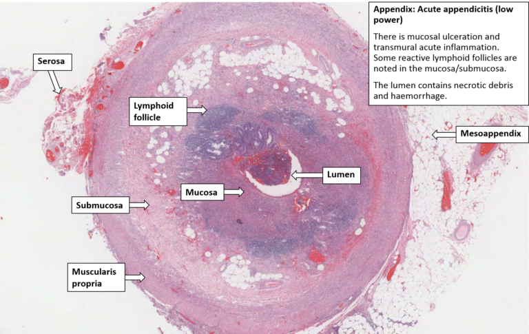 Appendix Acute Appendicitis NUS Pathweb NUS Pathweb Appendix Acute Appendicitis NUS Pathweb NUS Pathweb