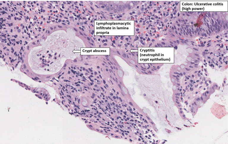 Colon Ulcerative Colitis Nus Pathweb Nus Pathweb