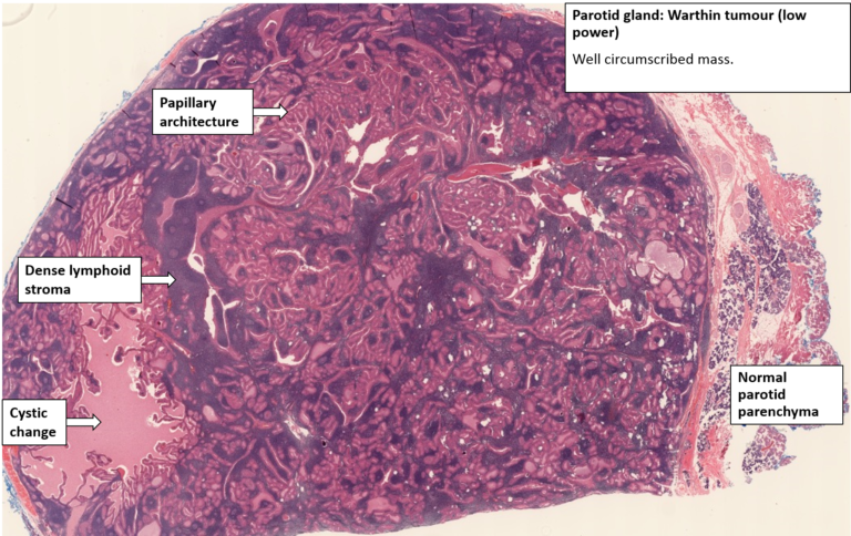 Salivary Gland – Warthin Tumour – NUS Pathweb :: NUS Pathweb