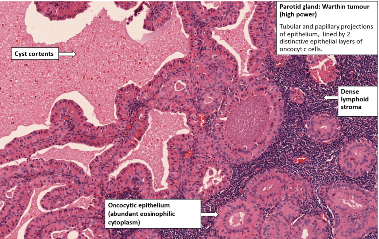 Salivary Gland – Warthin Tumour – NUS Pathweb :: NUS Pathweb