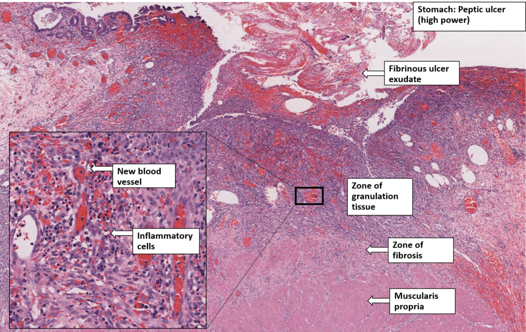 Stomach – Chronic Peptic Ulcer – NUS Pathweb :: NUS Pathweb