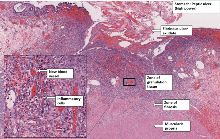 Stomach – Chronic Peptic Ulcer – NUS Pathweb :: NUS Pathweb