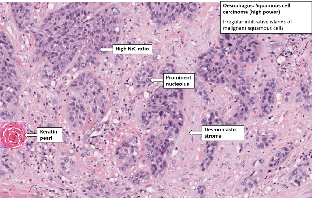 Oesophagus – Squamous Cell Carcinoma – NUS Pathweb :: NUS Pathweb