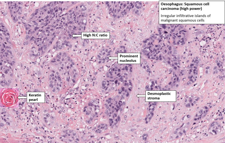 Oesophagus – Squamous Cell Carcinoma – NUS Pathweb :: NUS Pathweb