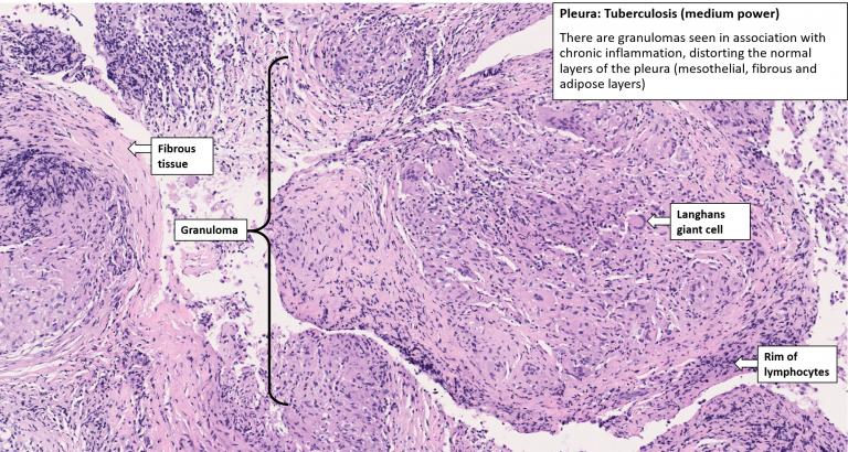 Lung – Tuberculosis with Cavitation – NUS Pathweb :: NUS Pathweb