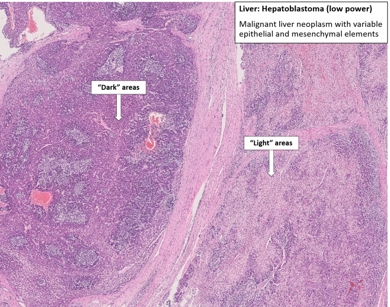 Liver – Hepatoblastoma – NUS Pathweb :: NUS Pathweb