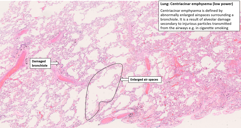 Lung – Emphysema – NUS Pathweb :: NUS Pathweb