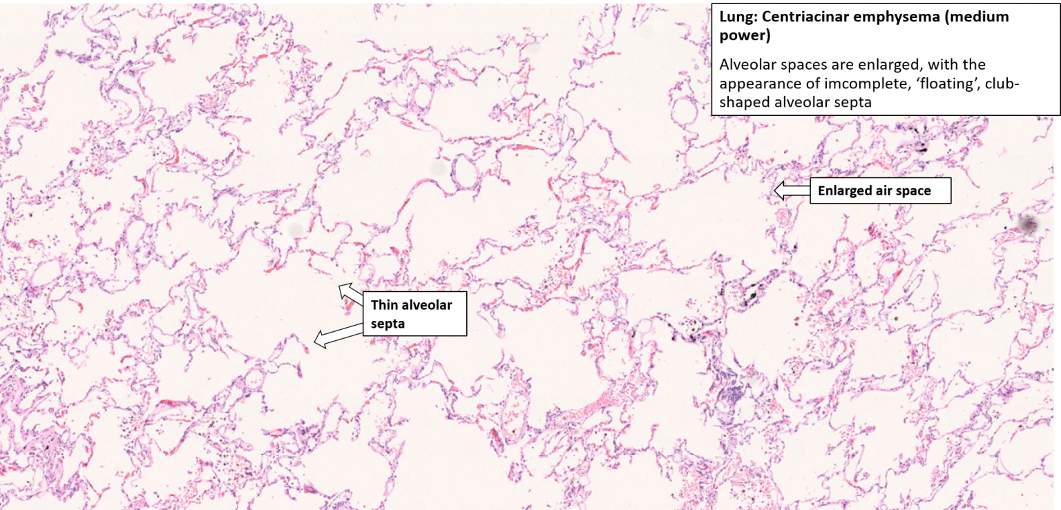 Lung – Emphysema – NUS Pathweb :: NUS Pathweb