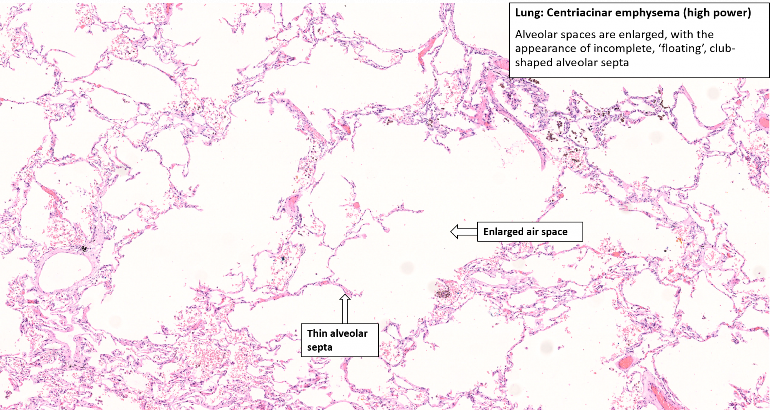 Lung – Emphysema – NUS Pathweb :: NUS Pathweb