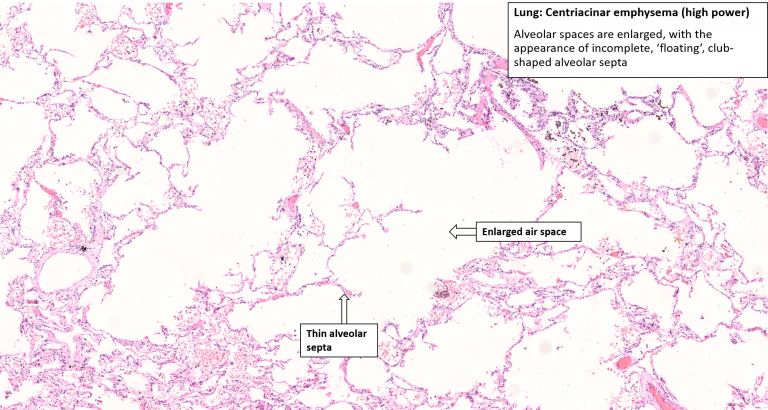 Lung – Emphysema – NUS Pathweb :: NUS Pathweb