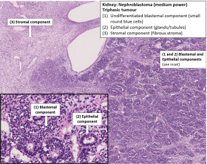 Kidney – Nephroblastoma – NUS Pathweb :: NUS Pathweb